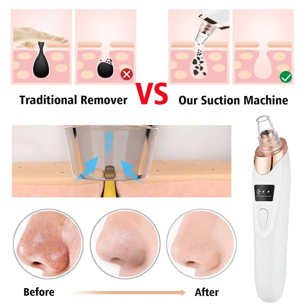 5 In 1 Black Head Remover Machine/bright skin